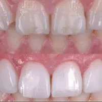 ونیر کامپوزیت هر واحد ۳ میلیون تومان