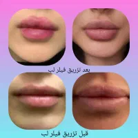 تزریق فیلر لب، فک ... فشیال و PRP
