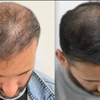 معجزه رشد مو با محصولات گیاهی و ارگانیک