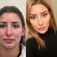 جراحی بینی لیفت بوتاکس نخ مزو فیلر فشیال|خدمات آرایشگری و زیبایی|شاهین‌شهر, عطار|دیوار