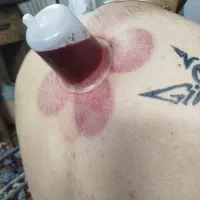 زالو درمانی و حجامت درطب سنتی با ۸ سال سابقه کار