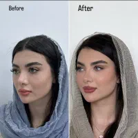 مرکز تخصصی لیفت نخ صورت فرم دهی بینی فول فیس