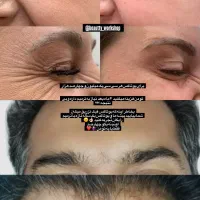 ژل بوتاکس مزوتراپی جوانساز فشیال پاکسازی|خدمات آرایشگری و زیبایی|اندیشه, اندیشه فاز ۱|دیوار