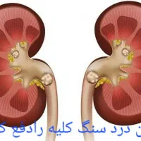 دوره تضمینی سنگ صفرا وکلیه