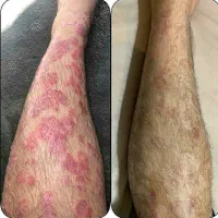 پیسی و پسوریازیس|خدمات آرایشگری و زیبایی|کرمانشاه, |دیوار