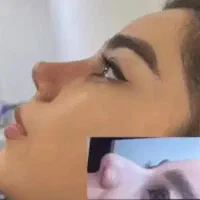 جراحی بینی دکتر اسدالله پور ۳۰میلیون