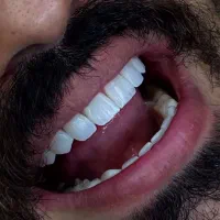 کامپوزیت دندان‌از دم‌اقساطی بدون پیش پرداخت