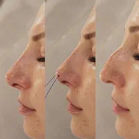 ژل وبوتاکس.افزایش سایزآلت آقا.لیفت بانخ توسط پزشک|خدمات آرایشگری و زیبایی|قم, صفائیه|دیوار