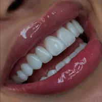 دندانپزشکی زیبایی روکش کامپوزیت عصبکشی ترمیم دندان|خدمات آرایشگری و زیبایی|تبریز, |دیوار