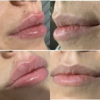 تزریق ژل و بوتاکس با بروزترین متد در نایس|خدمات زیبایی و سلامت|تبریز, |دیوار