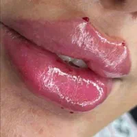 اف ویژه ژل بوتاکس بندرعباس|خدمات آرایشگری و زیبایی|بندرعباس, |دیوار