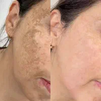 پاک کردن تتو بلفاروپلاستی لیپو غبغب در شهرری|خدمات آرایشگری و زیبایی|باقرشهر, |دیوار