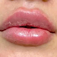 جشنواره ژل بوتاکس با موندگاری بالا