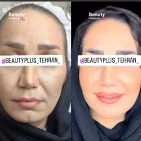 ساکشن غبغب وتزریق چربی بصورت و هرناحیه ازبدن درمطب|خدمات آرایشگری و زیبایی|قم, زنبیل آباد|دیوار