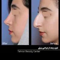 ، بلفارو ، تزریق چربی ، کاشت مو،جراحی بینی