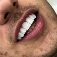 ۱۶ واحد کامپوزیت فقط ۱۶ تومن ضمانت کتبی
