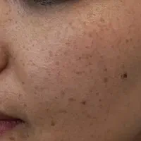 برداشتن لک و کک و مک|خدمات آرایشگری و زیبایی|نورآباد, |دیوار