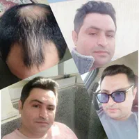 کاشت مو تخصصی در شیراز