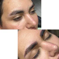 میکروبلیدینگ و فیبروز ابرو