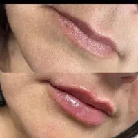 مزوتراپی،پی آر پی،پلاسما،آموزش پاکسازی|خدمات آرایشگری و زیبایی|اندیمشک, |دیوار