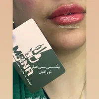 فرصت طلایی برای تزریق ژل و انواع فیلر بوتاکس|خدمات آرایشگری و زیبایی|بندرعباس, |دیوار