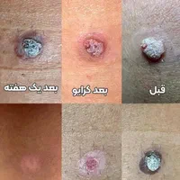 درمان قطعی زگیل میخچه و خال بدون بازگشت