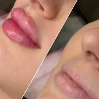 انزیم / تزریق با نتیجه طبیعی توسط پزشک