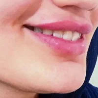 تزریق بوتاکس و ژل در کلینیک(توسط پزشک،)