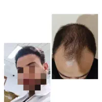 کاشت موی شیرازی درتهران