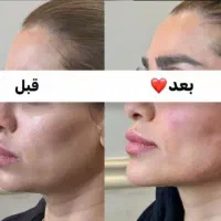 جشنواره تخفیفات یک روزه انجام فیلرزاویه فک وگونه|خدمات آرایشگری و زیبایی|تبریز, |دیوار