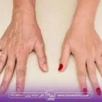 مدل فیشال دست و آبرسانی و جوان سازی