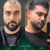 کاشت مو و ابرو کلینیک تارِنو
