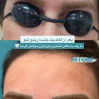 پاک کردن تتو