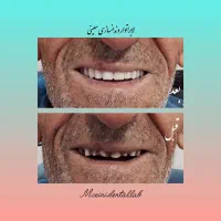 دندانسازی/دست دندان متحرک/سپیدان/هماشهر/همایجان|خدمات آرایشگری و زیبایی|شیراز, گویم|دیوار
