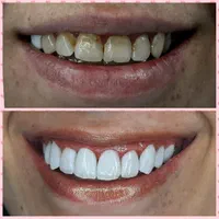 کامپوزیت دندان درمحل شمامنزل یامحل کار