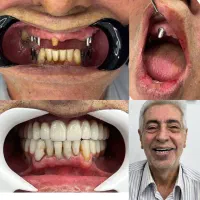 ایمپلنت یکروزه فقط با16تومان (بیمه واقساط)|خدمات زیبایی و سلامت|تهران, دردشت|دیوار
