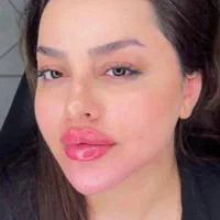 سوپرساکشن غبغب همراه بازاویه سازی تخصصی گردنُ صورت|خدمات آرایشگری و زیبایی|تهران, پاسداران|دیوار