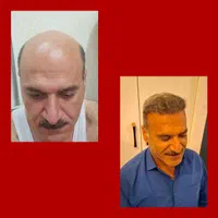 کاشت مو و ابرو در تبریز