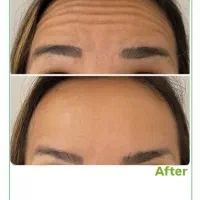 تخفیف ویژه بوتاکس فیلر فیشال لیزر فیشیال ژل|خدمات آرایشگری و زیبایی|فردیس, شهرک ۱۱۰|دیوار