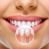 ایمپلنت اقساطی با وام بلند مدت بدون سود