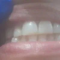 کاشت پرکردن ترمیم رفع پوسیدگی کامپوزیت مدل|خدمات آرایشگری و زیبایی|اهواز, کیانپارس |دیوار