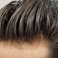 فروش ویژه پروتز مو