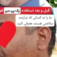 پوست چرب و جای جوش و آکنه|آرایشی، بهداشتی، درمانی|شیراز, لشکری|دیوار