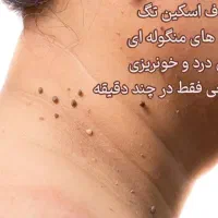 حذف فوری خال منگوله ای|آرایشی، بهداشتی، درمانی|رشت, علی آباد|دیوار