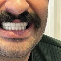 ایمپلنت باروکش سرامیکی فقط۱۶/۵۰۰ برند اسنوکن