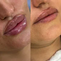 تزریق چربی صورت\فیلرلب/فیلربادی/بوکالفت/غبغب|خدمات آرایشگری و زیبایی|تهران, عبدلآباد|دیوار