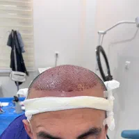 کاشت سر و ابرو