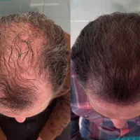 موهات تضمینی درمیاد