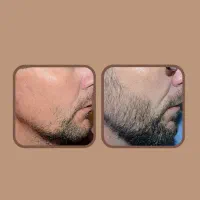 طی 25روز|آرایشی، بهداشتی، درمانی|فارسان, |دیوار