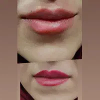 لیزر وزیبایی طلا|خدمات آرایشگری و زیبایی|سنندج, |دیوار